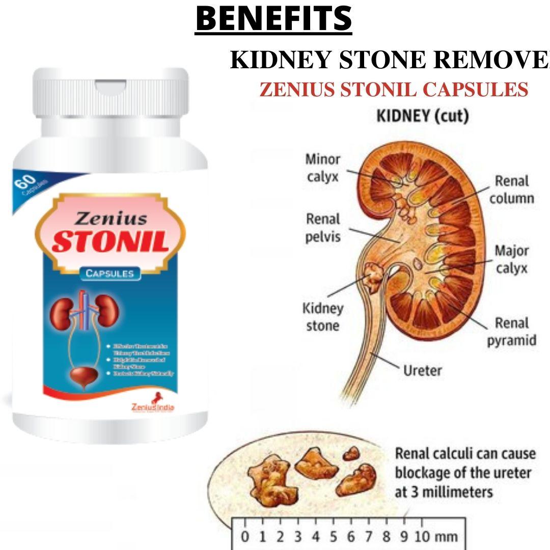 Zenius Stonil Capsule for Kidney Stone Removal Medicine | Kidney StoneZenius Stonil Capsule is the best Ayurvedic Medicine for Kidney Stone is precisely made for those who are looking for a treatment that can give them long term freedoGeneral WellnessZenius IndiaKidney Stone Treatment (60 Capsules)