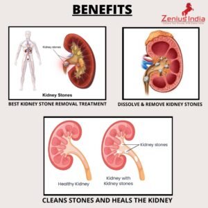 Zenius Stonil Capsule for Kidney Stone Removal Medicine | Kidney Stone Treatment (60 Capsules) - Image 4