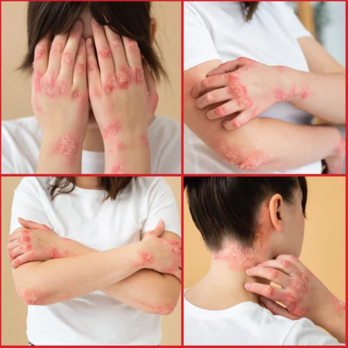 Zenius Psoriasis Care Oil - Image 4