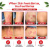 3 psoriasis-kit