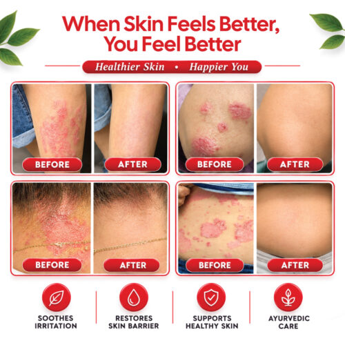 3 psoriasis-kit
